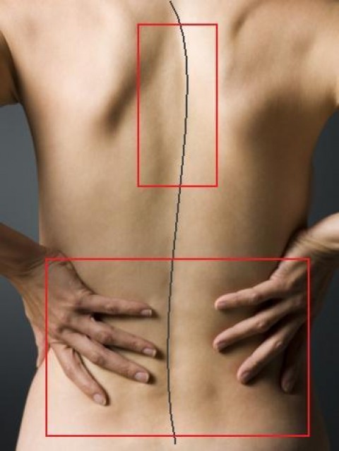 skoliosi ti na kano?