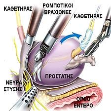 Υπέρηχος ουροποιητικού Αρτέμιδα, Λοιμώξεις ουροποιητικού, Προστατίτιδα, Κυστίτιδα, Ουρηθρίτιδα Λούτσα