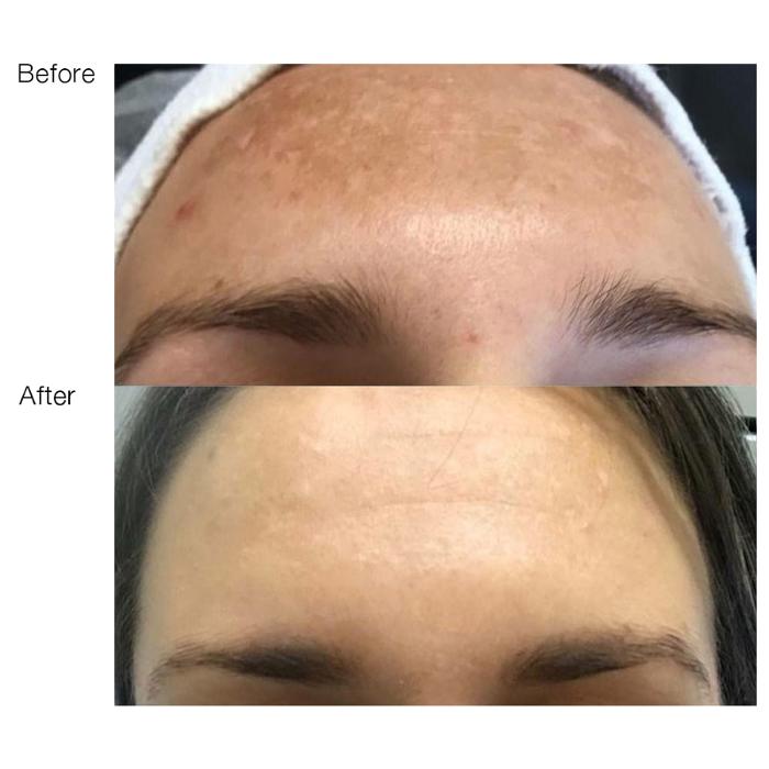 Θεραπείες Αδυνατίσματος Ραφήνα, Θεραπείες Κυτταρίτιδας, Θεραπεία Σύσφιξης