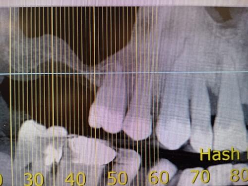Cbct ατροφικής άνω γνάθου δεξιά
